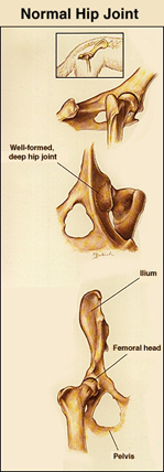 HIP DYSPLASIA